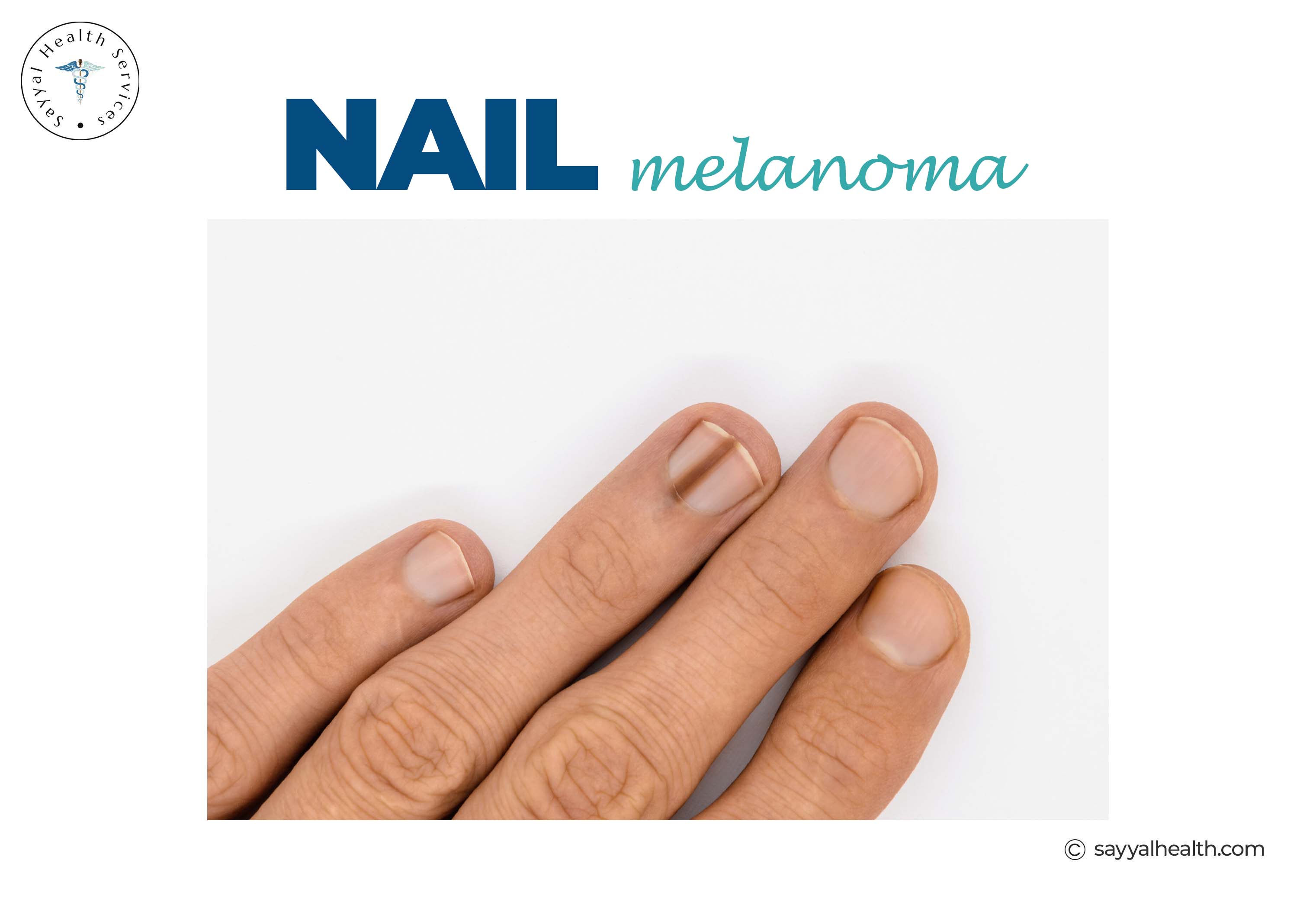 Nail melanoma displaying dark streaks on fingernails
